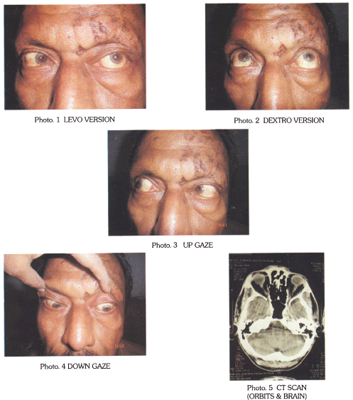 Ct+scan+brain+normal