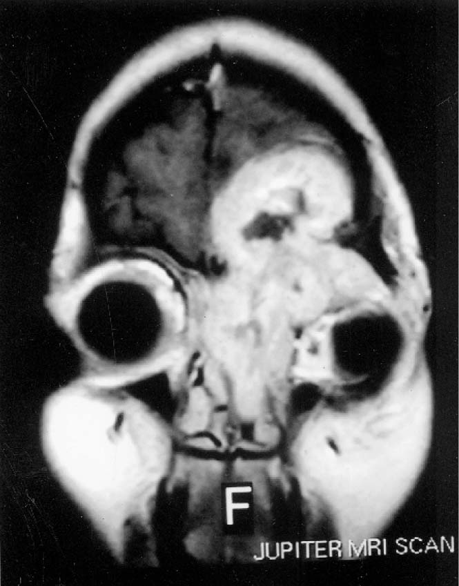 Nasal paraganglioma with orbital and cranial extension a rare case
