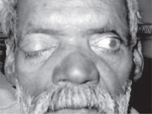 pinpoint pupils head injury pinpoint pupils head injury